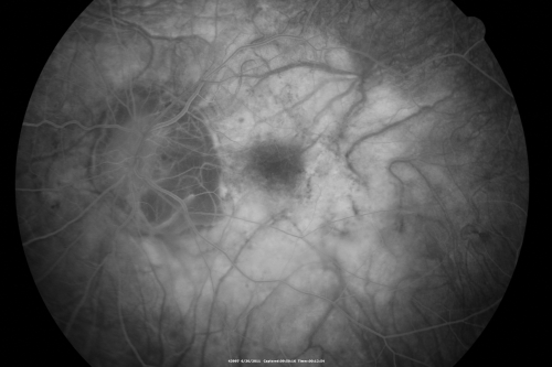 Myopic Traction Maculopathy - Vitreoretinal Traction - Possible Occult Neovascular Membrane
58-year-old woman was seen in the office on June 30, 2011. In 2002, her vision was 20/30.  Subsequent to that she had her left eye made her distance eye, which was dominate.  She had LASIK surgery on the right eye to make that her near eye and she was getting along well until about a year ago when she noticed substantial vision loss in the left eye only.  VISUAL ACUITY:  The near eye is 20/200, but she reads J2.   OS 20/100- and J16.
