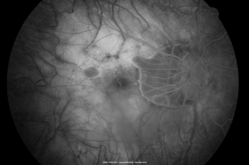 Myopic Traction Maculopathy - Vitreoretinal Traction - Possible Occult Neovascular Membrane
58-year-old woman was seen in the office on June 30, 2011. In 2002, her vision was 20/30.  Subsequent to that she had her left eye made her distance eye, which was dominate.  She had LASIK surgery on the right eye to make that her near eye and she was getting along well until about a year ago when she noticed substantial vision loss in the left eye only.  VISUAL ACUITY:  The near eye is 20/200, but she reads J2.   OS 20/100- and J16.
