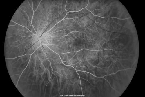 Myopic Macular Degeneration - Dry 
55-year-old woman has myopic macular degeneration in both eyes with vision and an Amsler grid change starting a few days ago in the left eye.
VISUAL ACUITY: OD: 20/60. PH: 20/25. OS: 20/200. PH: 20/30. 
Keywords: myopic macular degeneration; dry; lacquer cracks;