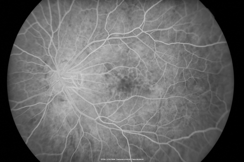 Myopic Macular Degeneration - Dry 
55-year-old woman has myopic macular degeneration in both eyes with vision and an Amsler grid change starting a few days ago in the left eye.
VISUAL ACUITY: OD: 20/60. PH: 20/25. OS: 20/200. PH: 20/30. 
Keywords: myopic macular degeneration; dry; lacquer cracks;