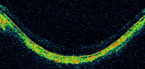 Myopic Macular Degeneration - Dry OCT OS
55-year-old woman has myopic macular degeneration in both eyes with vision and an Amsler grid change starting a few days ago in the left eye.
VISUAL ACUITY: OD: 20/60. PH: 20/25. OS: 20/200. PH: 20/30. 
Keywords: myopic macular degeneration; dry; lacquer cracks;