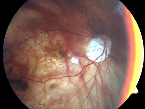 Myopic - Tilted - Optic Nerves with Torsion
 82-year-old man He had an injury when he was a child.  The right eye unfortunately has had poor vision since he is so nearsighted, even without a lens, he sees some out of the right eye. Vision OD is 20/100, OS is 20/20.  
Keywords: myopia;myopic;tilted disk;disc;torsion