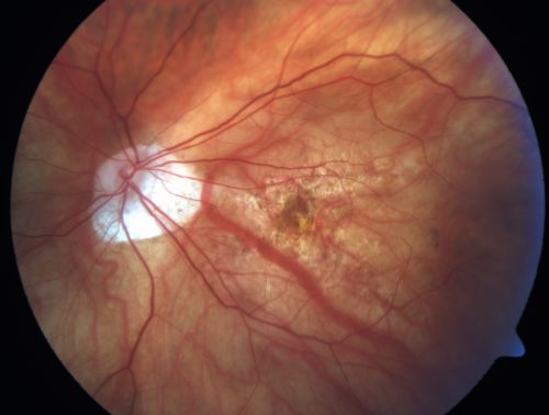 Myopic - Tilted - Optic Nerves with Torsion
  82-year-old man He had an injury when he was a child.  The right eye unfortunately has had poor vision since he is so nearsighted, even without a lens, he sees some out of the right eye. Vision OD is 20/100, OS is 20/20.  
Keywords: myopia;myopic;tilted disk;disc;torsion