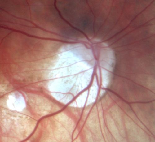 Myopic - Tilted - Optic Nerves with Torsion
 82-year-old man He had an injury when he was a child.  The right eye unfortunately has had poor vision since he is so nearsighted, even without a lens, he sees some out of the right eye. Vision OD is 20/100, OS is 20/20.  
Keywords: myopia;myopic;tilted disk;disc;torsion