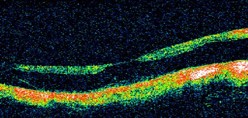 Myopic Traction Maculopathy - Vitreoretinal Traction - Possible Occult Neovascular Membrane
58-year-old woman was seen in the office on June 30, 2011. In 2002, her vision was 20/30.  Subsequent to that she had her left eye made her distance eye, which was dominate.  She had LASIK surgery on the right eye to make that her near eye and she was getting along well until about a year ago when she noticed substantial vision loss in the left eye only.  VISUAL ACUITY:  The near eye is 20/200, but she reads J2.   OS 20/100- and J16.
