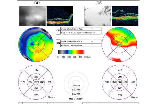 Myopic Traction Maculopathy - Vitreoretinal Traction - Possible Occult Neovascular Membrane
58-year-old woman was seen in the office on June 30, 2011. In 2002, her vision was 20/30.  Subsequent to that she had her left eye made her distance eye, which was dominate.  She had LASIK surgery on the right eye to make that her near eye and she was getting along well until about a year ago when she noticed substantial vision loss in the left eye only.  VISUAL ACUITY:  The near eye is 20/200, but she reads J2.   OS 20/100- and J16.
