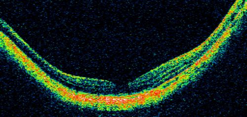 Myopic Choroidal Neovascular Membrane 54 year old woman 20/20
54-year-old woman has had problems in her vision in the right eye for about the last three months.  Inferotemporally she sees a gray area, which is distorted.   OD is 20/20, OS is 20/20
Keywords: myopic degeneration;wet;cnvm;