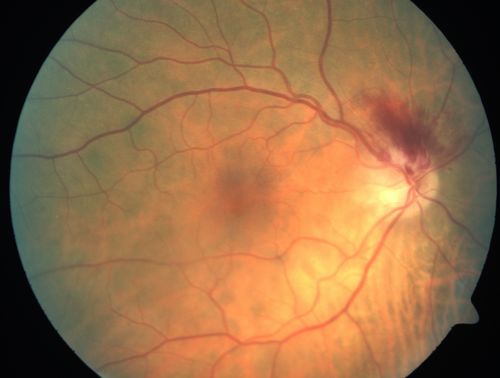Acute Non-arteritic Anterior Ischemic Optic Neuropathy Right Eye - Previous NA-AION left eye 
69-year-old man previously lost vision in the left eye from nonarteritic anterior ischemic optic neuropathy in 2006.  About a week ago and noticed blurred vision in the inferonasal part of the vision in the right eye.  

VISUAL ACUITY:  Vision OD is 20/16, OS is 20/40
