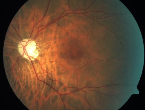Acute Non-arteritic Anterior Ischemic Optic Neuropathy Right Eye - Previous NA-AION left eye 
69-year-old man previously lost vision in the left eye from nonarteritic anterior ischemic optic neuropathy in 2006.  About a week ago and noticed blurred vision in the inferonasal part of the vision in the right eye.  

VISUAL ACUITY:  Vision OD is 20/16, OS is 20/40
