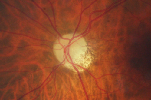 Acute Non-arteritic Anterior Ischemic Optic Neuropathy Right Eye - Previous NA-AION left eye 
69-year-old man previously lost vision in the left eye from nonarteritic anterior ischemic optic neuropathy in 2006.  About a week ago and noticed blurred vision in the inferonasal part of the vision in the right eye.  

VISUAL ACUITY:  Vision OD is 20/16, OS is 20/40

