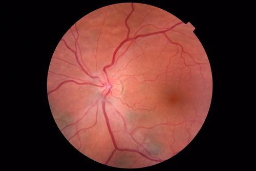 Nanophthalmous with Choroidal Folds
71 year old female with 20/20 vision and worsening cataracts.  There is also a CHRPE lesion in the periphery
