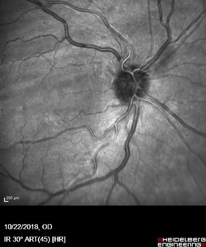Nanophthalmous with Choroidal Folds
71 year old female with 20/20 vision and worsening cataracts.  There is also a CHRPE lesion in the periphery
