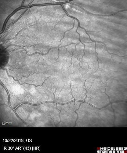 Nanophthalmous with Choroidal Folds
71 year old female with 20/20 vision and worsening cataracts.  There is also a CHRPE lesion in the periphery
