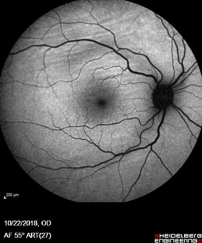Nanophthalmous with Choroidal Folds
71 year old female with 20/20 vision and worsening cataracts.  There is also a CHRPE lesion in the periphery
