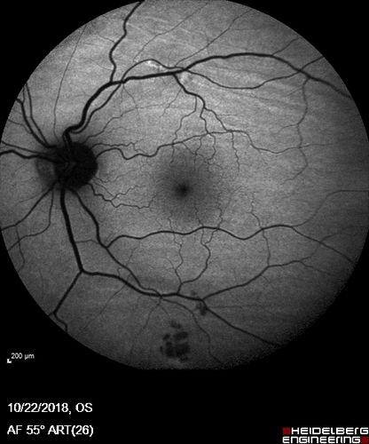 Nanophthalmous with Choroidal Folds
71 year old female with 20/20 vision and worsening cataracts.  There is also a CHRPE lesion in the periphery

