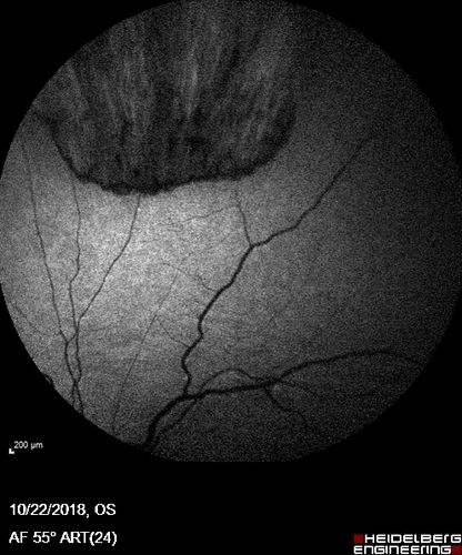 Nanophthalmous with Choroidal Folds
71 year old female with 20/20 vision and worsening cataracts.  There is also a CHRPE lesion in the periphery
