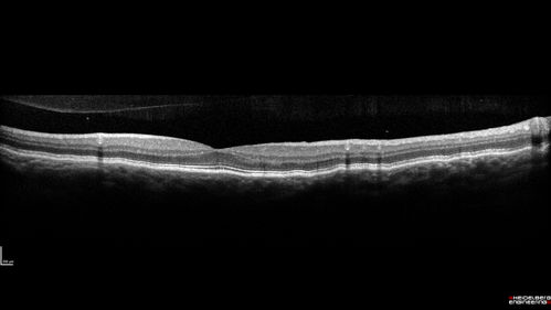 Nanophthalmous with Choroidal Folds
71 year old female with 20/20 vision and worsening cataracts.  There is also a CHRPE lesion in the periphery
