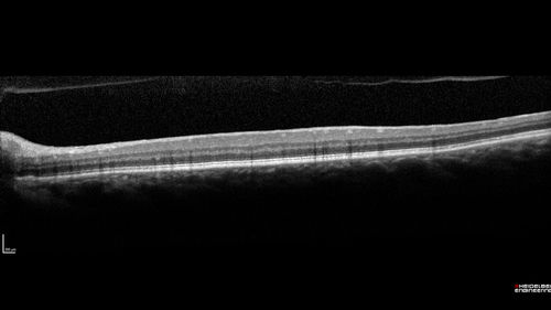 Nanophthalmous with Choroidal Folds
71 year old female with 20/20 vision and worsening cataracts.  There is also a CHRPE lesion in the periphery
