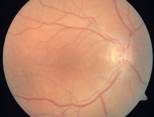 Nanopthalmous (Microphthalmous) Chorioretinal Folds and Choroidal Thickening Both Eyes
67-year-old woman with microphthalmos/nanophthalmos  Her vision has gradually been getting a little bit worse, especially in the right eye.  Also the anterior chamber is getting crowded and there is concern about the need for cataract surgery.  She has one sister and one cousin who also have nanophthalmos.

VISUAL ACUITY:  OD 20/50,  OS 20/80.
