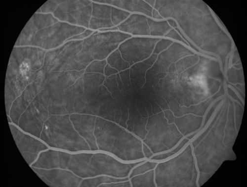 Nanopthalmous (Microphthalmous) Chorioretinal Folds and Choroidal Thickening Both Eyes
67-year-old woman with microphthalmos/nanophthalmos  Her vision has gradually been getting a little bit worse, especially in the right eye.  Also the anterior chamber is getting crowded and there is concern about the need for cataract surgery.  She has one sister and one cousin who also have nanophthalmos.

VISUAL ACUITY:  OD 20/50,  OS 20/80.
