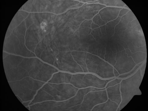 Nanopthalmous (Microphthalmous) Chorioretinal Folds and Choroidal Thickening Both Eyes
67-year-old woman with microphthalmos/nanophthalmos  Her vision has gradually been getting a little bit worse, especially in the right eye.  Also the anterior chamber is getting crowded and there is concern about the need for cataract surgery.  She has one sister and one cousin who also have nanophthalmos.

VISUAL ACUITY:  OD 20/50,  OS 20/80.
