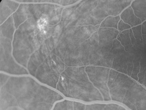 Nanopthalmous (Microphthalmous) Chorioretinal Folds and Choroidal Thickening Both Eyes
67-year-old woman with microphthalmos/nanophthalmos  Her vision has gradually been getting a little bit worse, especially in the right eye.  Also the anterior chamber is getting crowded and there is concern about the need for cataract surgery.  She has one sister and one cousin who also have nanophthalmos.

VISUAL ACUITY:  OD 20/50,  OS 20/80.
