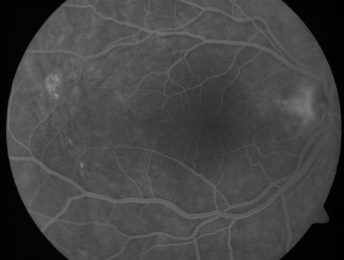 Nanopthalmous (Microphthalmous) Chorioretinal Folds and Choroidal Thickening Both Eyes
67-year-old woman with microphthalmos/nanophthalmos  Her vision has gradually been getting a little bit worse, especially in the right eye.  Also the anterior chamber is getting crowded and there is concern about the need for cataract surgery.  She has one sister and one cousin who also have nanophthalmos.

VISUAL ACUITY:  OD 20/50,  OS 20/80.
