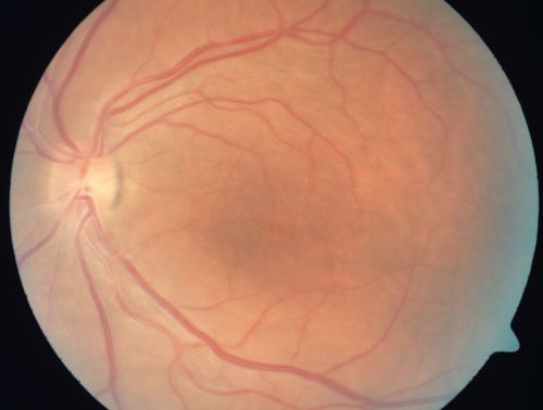Nanopthalmous (Microphthalmous) Chorioretinal Folds and Choroidal Thickening Both Eyes
67-year-old woman with microphthalmos/nanophthalmos  Her vision has gradually been getting a little bit worse, especially in the right eye.  Also the anterior chamber is getting crowded and there is concern about the need for cataract surgery.  She has one sister and one cousin who also have nanophthalmos.

VISUAL ACUITY:  OD 20/50,  OS 20/80.
