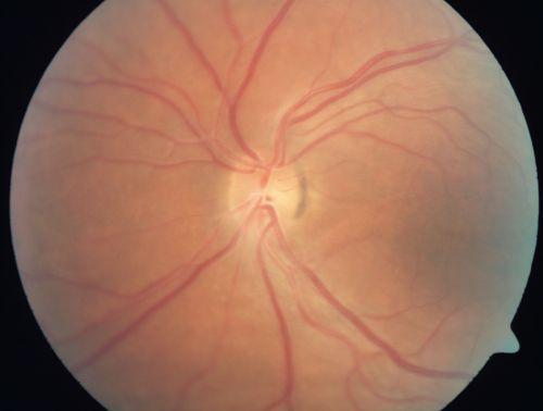 Nanopthalmous (Microphthalmous) Chorioretinal Folds and Choroidal Thickening Both Eyes
67-year-old woman with microphthalmos/nanophthalmos  Her vision has gradually been getting a little bit worse, especially in the right eye.  Also the anterior chamber is getting crowded and there is concern about the need for cataract surgery.  She has one sister and one cousin who also have nanophthalmos.

VISUAL ACUITY:  OD 20/50,  OS 20/80.
