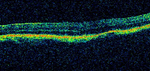 Nanopthalmous (Microphthalmous) Chorioretinal Folds and Choroidal Thickening Both Eyes
67-year-old woman with microphthalmos/nanophthalmos  Her vision has gradually been getting a little bit worse, especially in the right eye.  Also the anterior chamber is getting crowded and there is concern about the need for cataract surgery.  She has one sister and one cousin who also have nanophthalmos.

VISUAL ACUITY:  OD 20/50,  OS 20/80.
