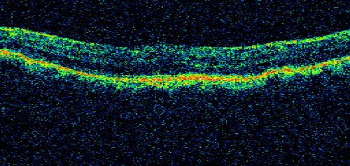 Nanopthalmous (Microphthalmous) Chorioretinal Folds and Choroidal Thickening Both Eyes
67-year-old woman with microphthalmos/nanophthalmos  Her vision has gradually been getting a little bit worse, especially in the right eye.  Also the anterior chamber is getting crowded and there is concern about the need for cataract surgery.  She has one sister and one cousin who also have nanophthalmos.

VISUAL ACUITY:  OD 20/50,  OS 20/80.
