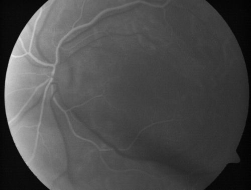 Nanopthalmous (Microphthalmous) Chorioretinal Folds and Choroidal Thickening Both Eyes
67-year-old woman with microphthalmos/nanophthalmos  Her vision has gradually been getting a little bit worse, especially in the right eye.  Also the anterior chamber is getting crowded and there is concern about the need for cataract surgery.  She has one sister and one cousin who also have nanophthalmos.

VISUAL ACUITY:  OD 20/50,  OS 20/80.
