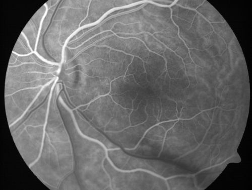 Nanopthalmous (Microphthalmous) Chorioretinal Folds and Choroidal Thickening Both Eyes
67-year-old woman with microphthalmos/nanophthalmos  Her vision has gradually been getting a little bit worse, especially in the right eye.  Also the anterior chamber is getting crowded and there is concern about the need for cataract surgery.  She has one sister and one cousin who also have nanophthalmos.

VISUAL ACUITY:  OD 20/50,  OS 20/80.
