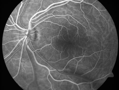 Nanopthalmous (Microphthalmous) Chorioretinal Folds and Choroidal Thickening Both Eyes
67-year-old woman with microphthalmos/nanophthalmos  Her vision has gradually been getting a little bit worse, especially in the right eye.  Also the anterior chamber is getting crowded and there is concern about the need for cataract surgery.  She has one sister and one cousin who also have nanophthalmos.

VISUAL ACUITY:  OD 20/50,  OS 20/80.
