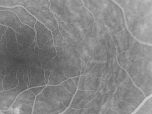 Nanopthalmous (Microphthalmous) Chorioretinal Folds and Choroidal Thickening Both Eyes
67-year-old woman with microphthalmos/nanophthalmos  Her vision has gradually been getting a little bit worse, especially in the right eye.  Also the anterior chamber is getting crowded and there is concern about the need for cataract surgery.  She has one sister and one cousin who also have nanophthalmos.

VISUAL ACUITY:  OD 20/50,  OS 20/80.
