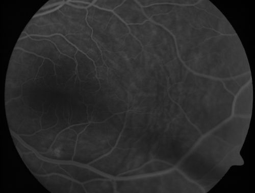Nanopthalmous (Microphthalmous) Chorioretinal Folds and Choroidal Thickening Both Eyes
67-year-old woman with microphthalmos/nanophthalmos  Her vision has gradually been getting a little bit worse, especially in the right eye.  Also the anterior chamber is getting crowded and there is concern about the need for cataract surgery.  She has one sister and one cousin who also have nanophthalmos.

VISUAL ACUITY:  OD 20/50,  OS 20/80.
