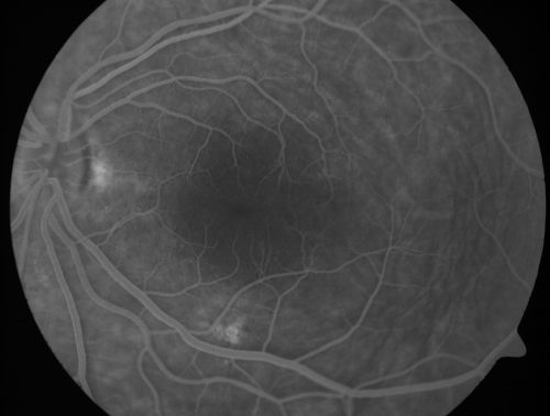 Nanopthalmous (Microphthalmous) Chorioretinal Folds and Choroidal Thickening Both Eyes
67-year-old woman with microphthalmos/nanophthalmos  Her vision has gradually been getting a little bit worse, especially in the right eye.  Also the anterior chamber is getting crowded and there is concern about the need for cataract surgery.  She has one sister and one cousin who also have nanophthalmos.

VISUAL ACUITY:  OD 20/50,  OS 20/80.

