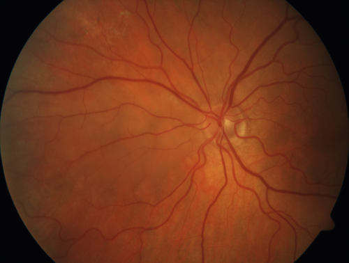 Cilioretinal Artery Occlusion - Nasal (not macular)
77 year old female There is a shadow in the top half of her temporal vision in the left eye that came on suddenly yesterday morning.Â  It has not changed since then and the right eye is OK.Â  She has had sinus headaches.Â  She had no focal neurological changes.Â Â 
VA OD: Dcc20/32 
VA OS: Dcc20/16-1 
IOP: TP: OD:18 OS:19Â 
