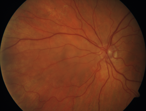 Cilioretinal Artery Occlusion - Nasal (not macular)
77 year old female There is a shadow in the top half of her temporal vision in the left eye that came on suddenly yesterday morning.Â  It has not changed since then and the right eye is OK.Â  She has had sinus headaches.Â  She had no focal neurological changes.Â Â 
VA OD: Dcc20/32 
VA OS: Dcc20/16-1 
IOP: TP: OD:18 OS:19Â 
