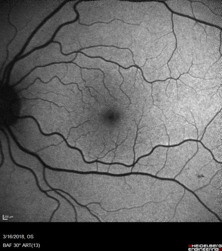 Cilioretinal Artery Occlusion - Nasal (not macular)
77 year old female There is a shadow in the top half of her temporal vision in the left eye that came on suddenly yesterday morning.Â  It has not changed since then and the right eye is OK.Â  She has had sinus headaches.Â  She had no focal neurological changes.Â Â 
VA OD: Dcc20/32 
VA OS: Dcc20/16-1 
IOP: TP: OD:18 OS:19Â 

