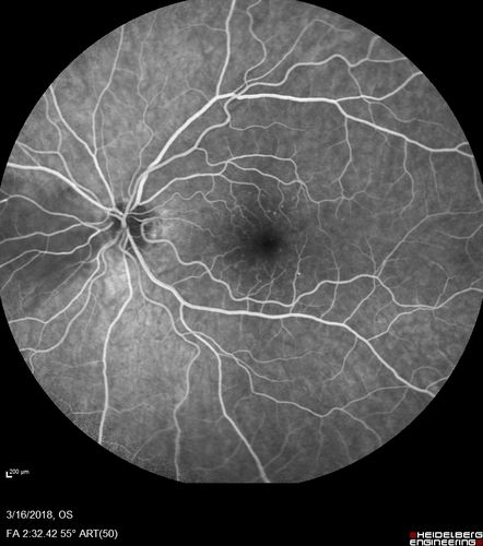 Cilioretinal Artery Occlusion - Nasal (not macular)
77 year old female There is a shadow in the top half of her temporal vision in the left eye that came on suddenly yesterday morning.Â  It has not changed since then and the right eye is OK.Â  She has had sinus headaches.Â  She had no focal neurological changes.Â Â 
VA OD: Dcc20/32 
VA OS: Dcc20/16-1 
IOP: TP: OD:18 OS:19Â 
