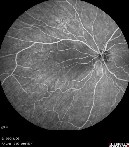 Cilioretinal Artery Occlusion - Nasal (not macular)
77 year old female There is a shadow in the top half of her temporal vision in the left eye that came on suddenly yesterday morning.Â  It has not changed since then and the right eye is OK.Â  She has had sinus headaches.Â  She had no focal neurological changes.Â Â 
VA OD: Dcc20/32 
VA OS: Dcc20/16-1 
IOP: TP: OD:18 OS:19Â 
