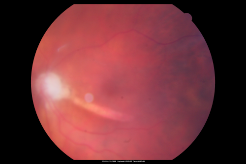 Retrobulbar Needle Stick Macular Left Eye with Scar - Anesthetic Complication
79-year-old woman has a macular pucker in the right eye.  She also has a macular scar in the left eye from a retrobulbar needle stick.     OD 20/80

