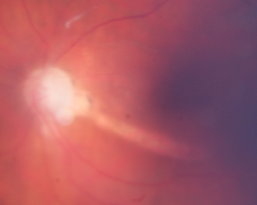 Retrobulbar Needle Stick Macular Left Eye with Scar - Anesthetic Complication
79-year-old woman has a macular pucker in the right eye.  She also has a macular scar in the left eye from a retrobulbar needle stick.     OD 20/80
