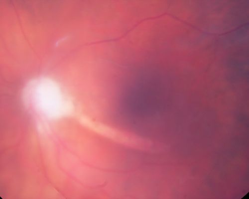 Retrobulbar Needle Stick Macular Left Eye with Scar - Anesthetic Complication
79-year-old woman has a macular pucker in the right eye.  She also has a macular scar in the left eye from a retrobulbar needle stick.     OD 20/80
