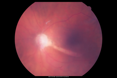 Retrobulbar Needle Stick Macular Left Eye with Scar - Anesthetic Complication
79-year-old woman has a macular pucker in the right eye.  She also has a macular scar in the left eye from a retrobulbar needle stick.     OD 20/80
