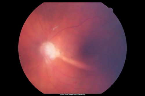 Retrobulbar Needle Stick Macular Left Eye with Scar - Anesthetic Complication
79-year-old woman has a macular pucker in the right eye.  She also has a macular scar in the left eye from a retrobulbar needle stick.     OD 20/80
