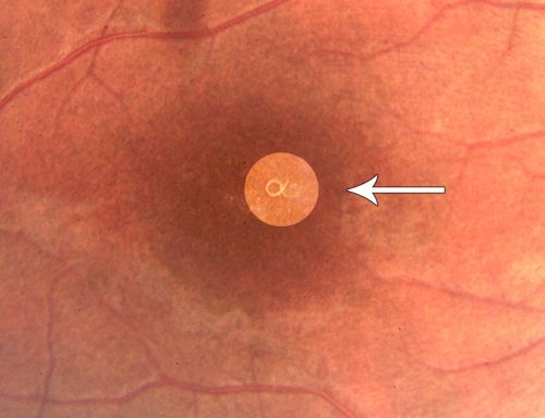 DUSN - Diffuse Unilateral Subacute Neuroretinitis - Nematode
