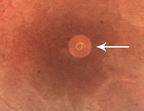 DUSN - Diffuse Unilateral Subacute Neuroretinitis - Nematode
