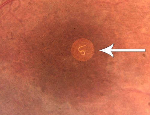 DUSN - Diffuse Unilateral Subacute Neuroretinitis - Nematode
